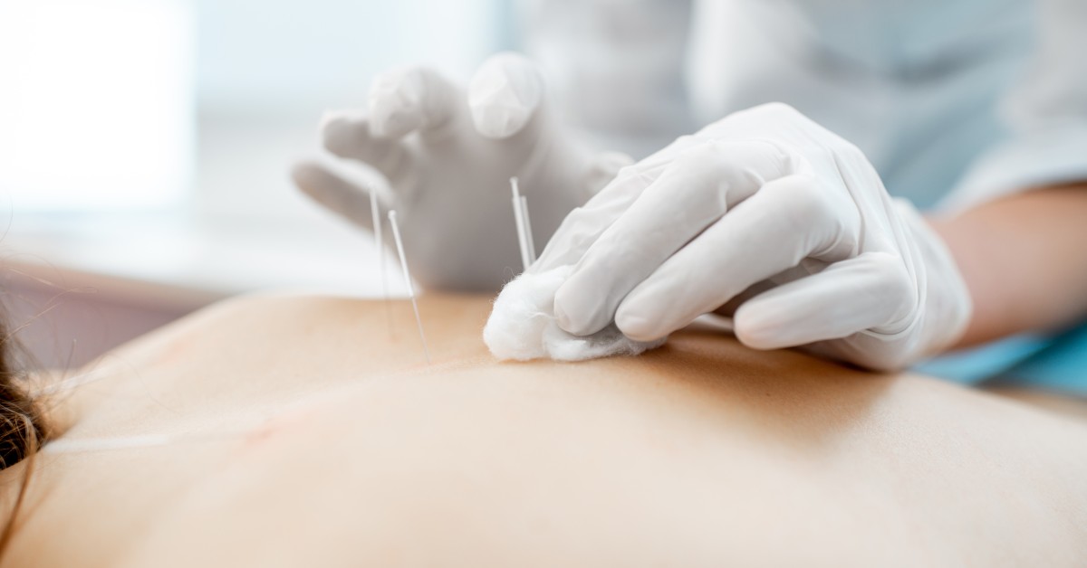 14 Amazing Benefits of Acupuncture You Should Know! American