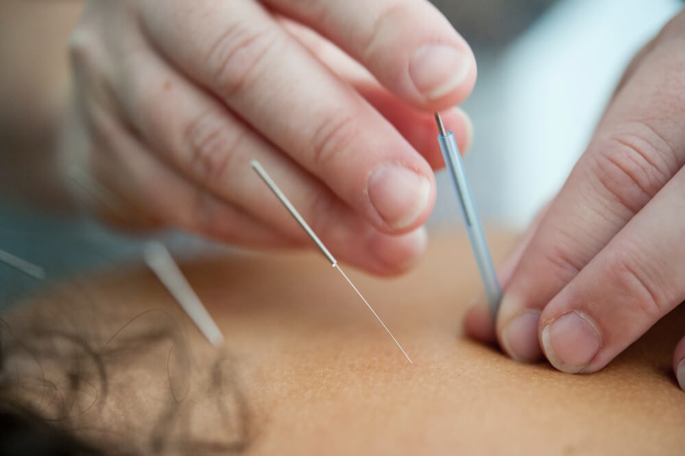 what-is-acupuncture