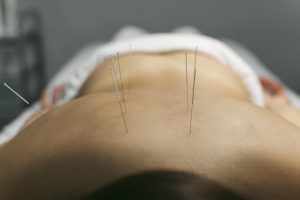 acupuncture-for-pain-relief