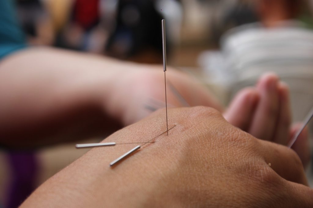 Ear Acupuncture Points & Techniques - American Institute of Alternative ...