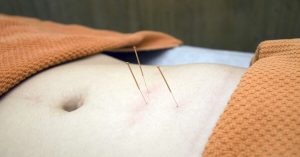 acupuncture-for-fertility-a-holistic-approach